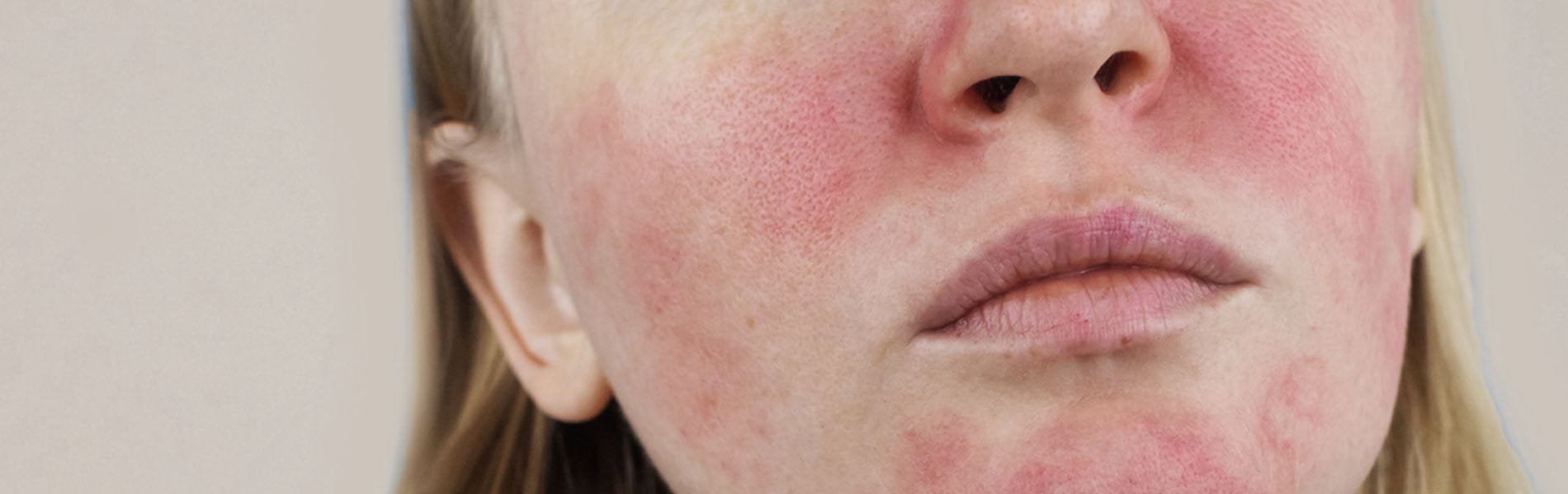 Understanding Rosacea How LED Light Therapy Can Help